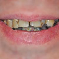 Smile in a Day - Smile 4 before